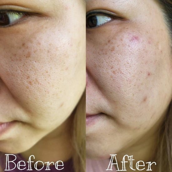 After 10 days of use, my skin is brighter with a more even tone. Pigmentation and dark spots are lighter, though red zits still come and go monthly.